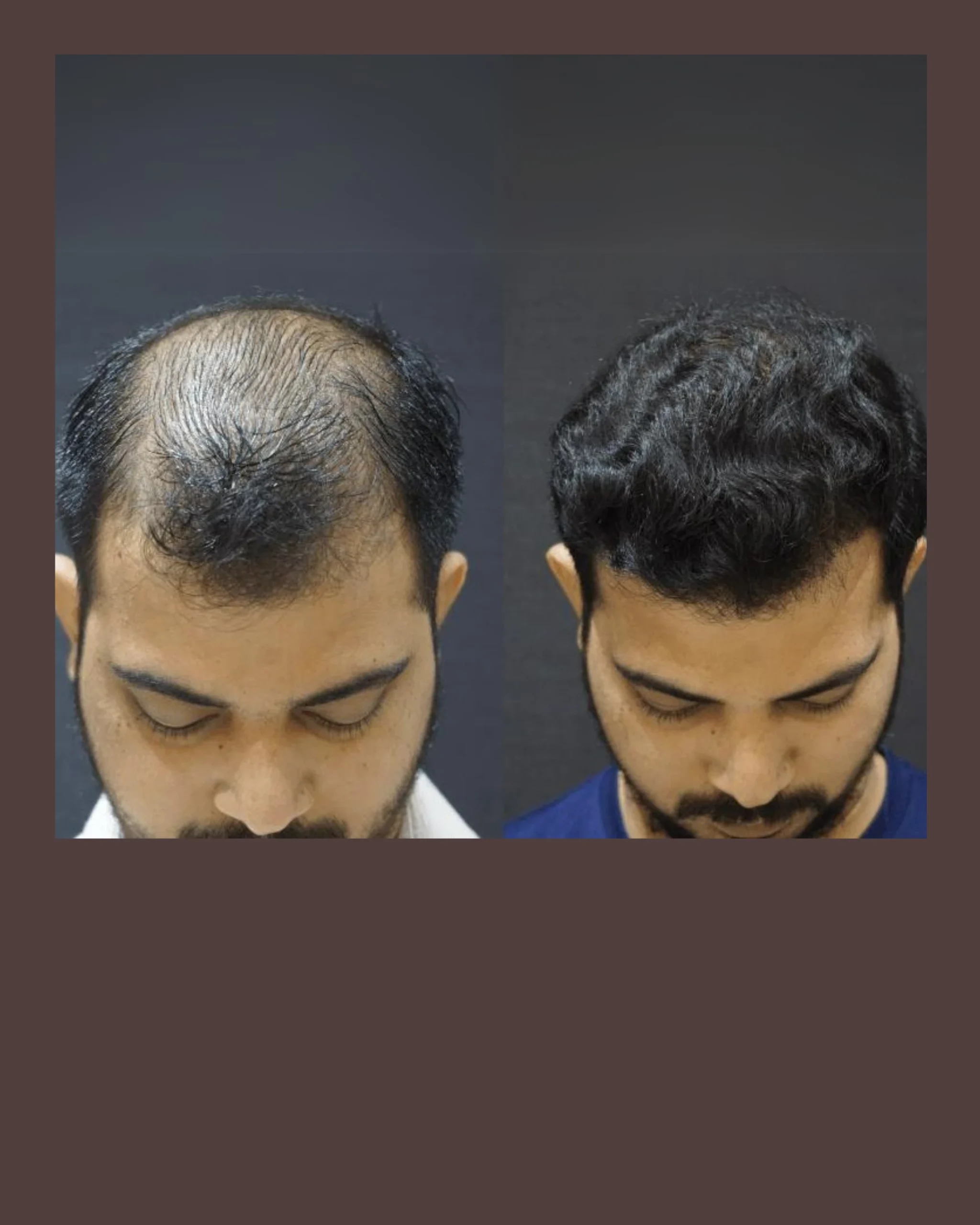 Non-surgical hair restoration Basavanagudi Bangalore