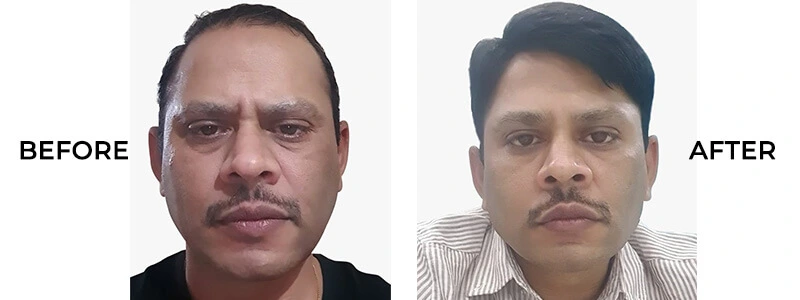 Hair bonding price Uttarahalli Bangalore