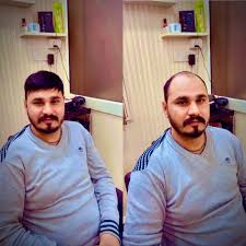 Instant hair fixing Kumaraswamy Layout Bangalore